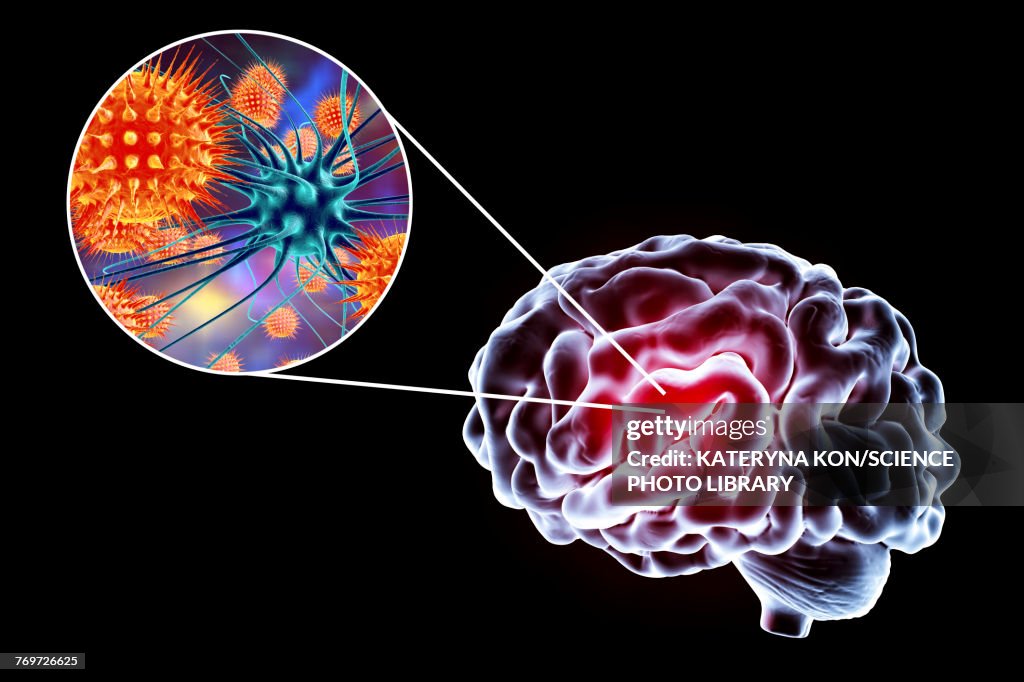 Viral encephalitis, illustration