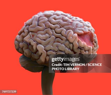 Brain damage, illustration Brain damage, illustration