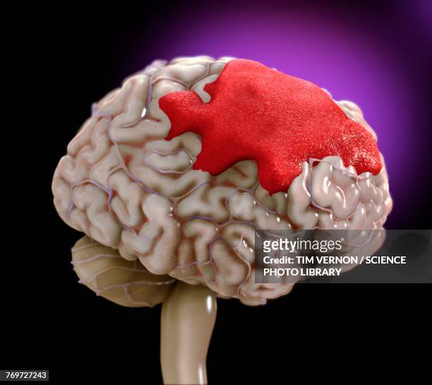 brain haemorrhage, illustration - hemorrhage stock illustrations