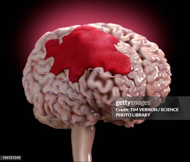 brain haemorrhage, illustration - hemorrhage stock illustrations