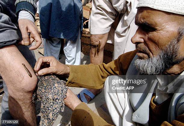 Kashmiri traditional healer Abdul Wahab applies a leech to the leg of a patient near the Hazratbal Mosque on the outskirts of Srinagar, 28 September...