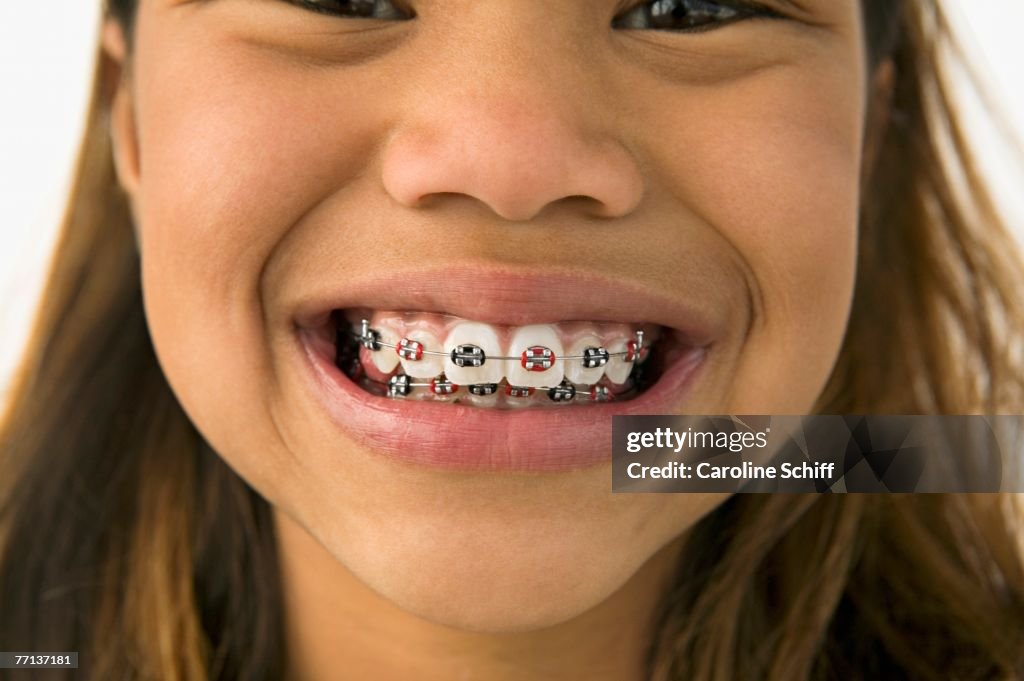 Asian girl smiling with braces