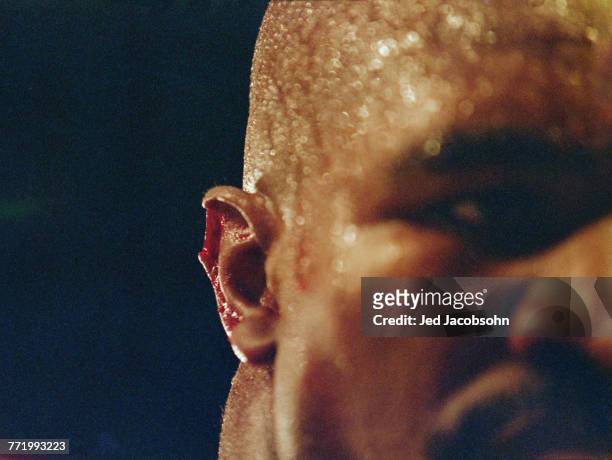 Close-up of the injury to the right ear of Evander Holyfield after Mike Tyson bit off a piece of it in the third round of their World Boxing...