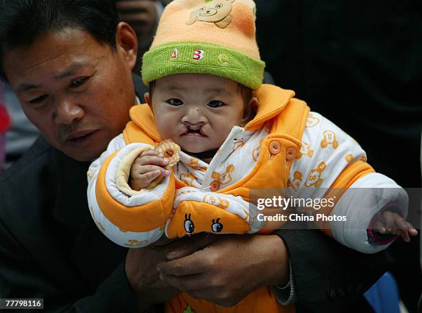 Child suffering from a cleft lip and palate waits for an examination at the Nanjing Drum Tower Hospital during registration for treatment at a...