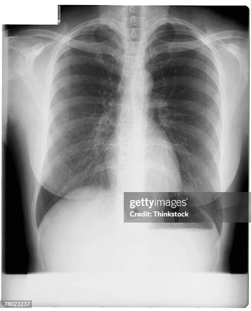 x-ray of ribcage - sleutelbeen stockfoto's en -beelden