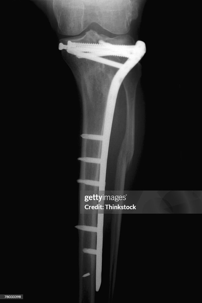 Medical x-ray of screws holding a metal plate to the knee of a person's broken leg
