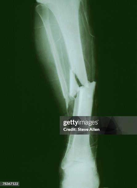 132 Broken Leg Xray Stock Photos, High-Res Pictures, and Images - Getty ...