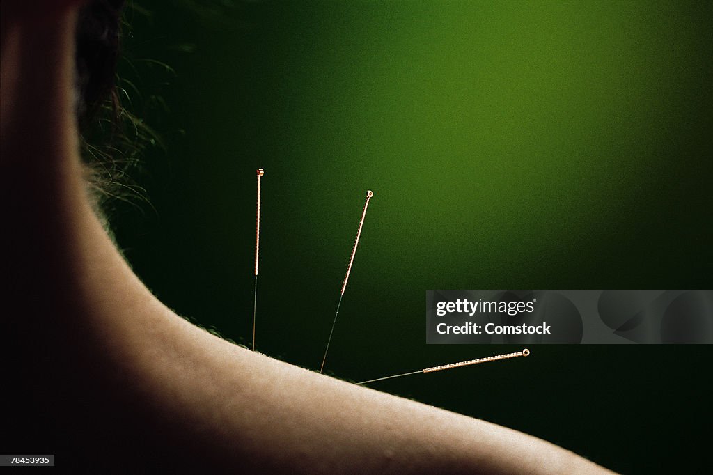 Acupuncture needles in neck and shoulder