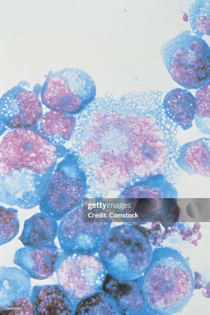 HIV-infected T-cells under high magnification