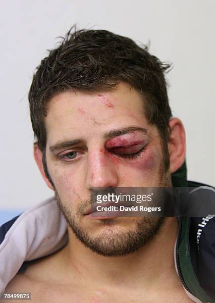 Kieran Roche of London Irish sits in the dressing room after being punched during the Heineken Cup match between Perpignan and London Irish at Stade...