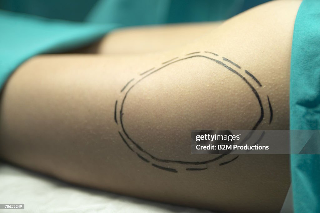 Leg of woman with incision diagram