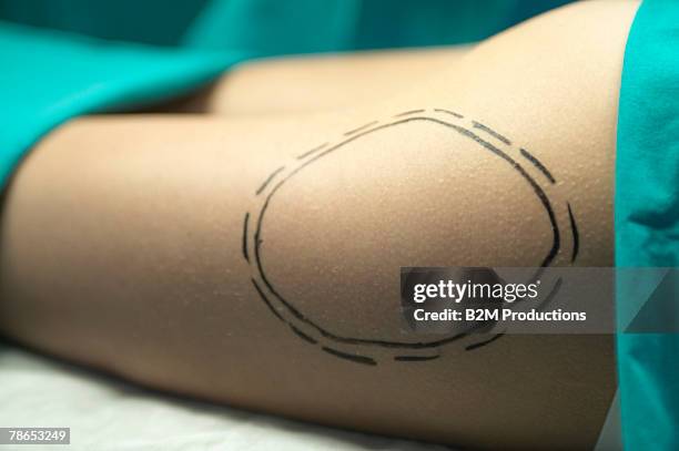 Leg Of Woman With Incision Diagram, Foto de stock