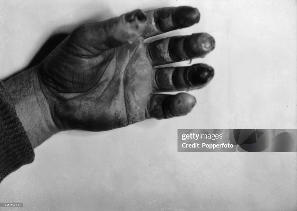 H.G Ponting. Captain Scott+s Antarctic Expedition 1910 - 1912. 5th July, 1911. A close up showing the frostbitten hand of Dr. Atkinson.