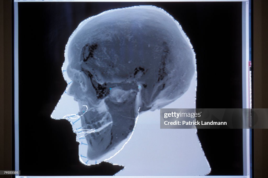 FRA: Otzi The Iceman