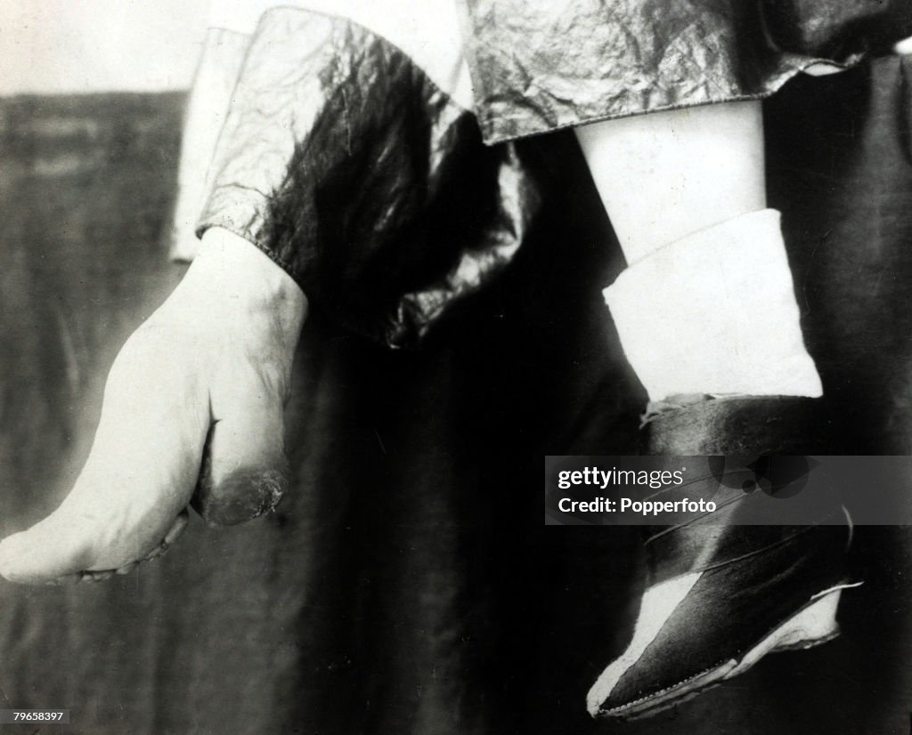 Oddities, China, pic: circa 1880, The bound foot of a southern Chinese woman, (Lily feet)