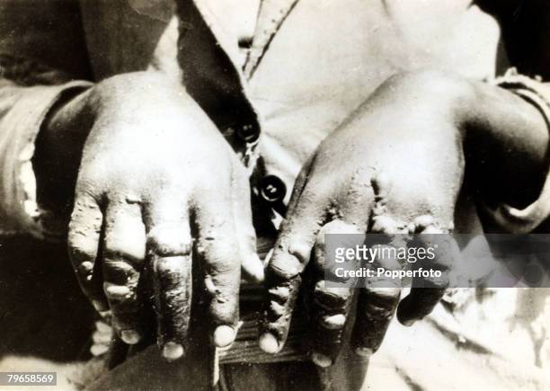 War and Conflict, The Abyssinia - Italy War, pic: circa 1936, An Abyssinian soldier with badly blistered hands, showing the effects of mustard gas...