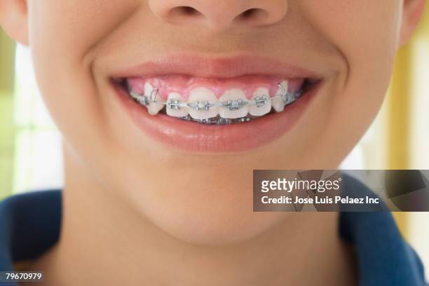 close up of braces hispanic boy's teeth - teeth braces stock pictures, royalty-free photos & images