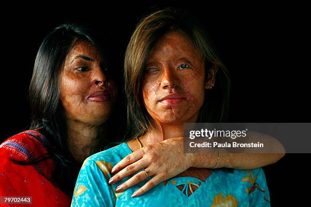 Saira Liaqat a victim of acid violence who was burned 4 years ago, poses with friend and fellow acid survivor Sabra Sultana in Islamabad, June 11,...