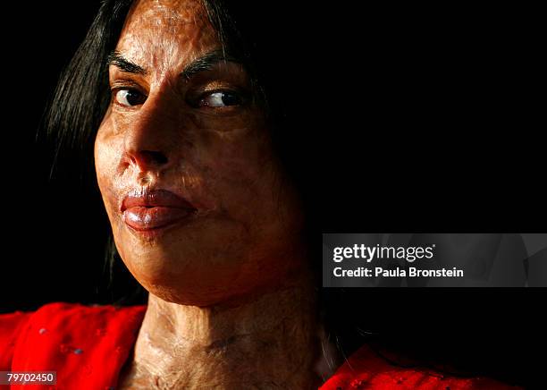 Sabra Sultana a victim of acid violence poses in Islamabad on June 11, 2007. Sabra was burned at the age of 15, a child bride married off to an older...