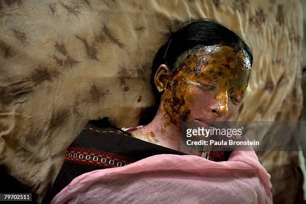 Saeeda Bukhsh an acid burn victim, rests in a burn ward at the Nishtar hospital in Multan June 20, 2007 in Multan, Punjab, Pakistan. Saeeda was...