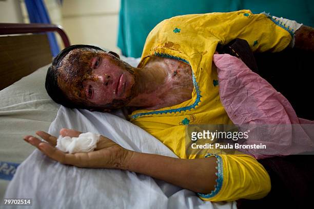 Saeeda Bukhsh an acid burn victim, rests in a burn ward at the Nishtar hospital in Multan June 20, 2007 in Multan, Punjab, Pakistan. Saeeda was...