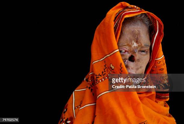 Bashiran Bibi from Sukhiki in the Punjab region poses showing a face that is severly deformed from her burns June 24, 2007 in Islamabad, Pakistan....