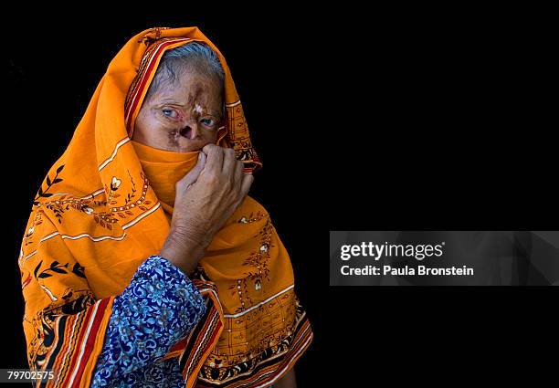 Bashiran Bibi from Sukhiki in the Punjab region poses showing a face that is severly deformed from her burns June 24, 2007 in Islamabad, Pakistan....