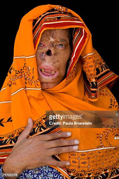 Bashiran Bibi from Sukhiki in the Punjab region poses showing a face that is severly deformed from her burns June 24, 2007 in Islamabad, Pakistan....