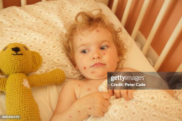 toddler in bed with chicken pox - chickenpox stock-fotos und bilder