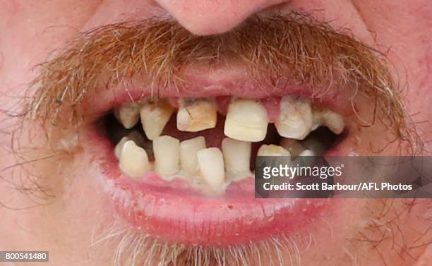 Detail of the teeth of a Bulldogs fan in the crowd as he watches the match during the 2017 VFL round 10 match between the Footscray Bulldogs and the...