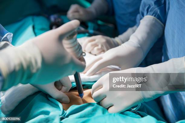 doctors in scrubs operating on a patient using instruments - surgical pin stock pictures, royalty-free photos & images