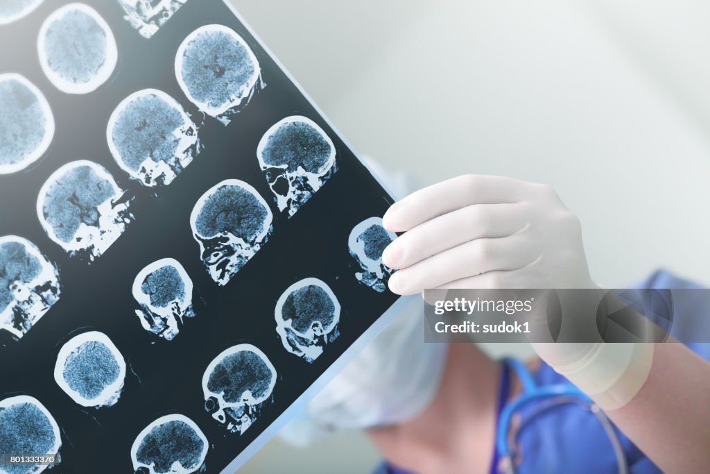 Medical experts studied the EEG condition of the patient