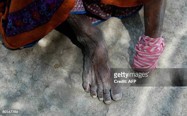 Eighty year old Indian woman Vahaliben Ramsingbhai Bhimani shows her bandaged amputated leg as she sits outside her home in the Little Rann of Kutch...