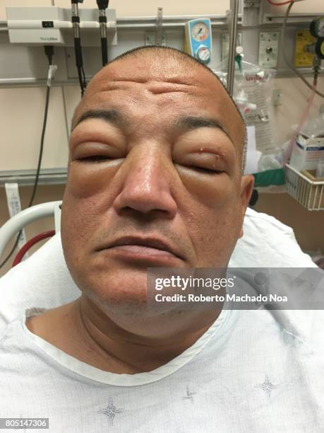 seafood allergy: adult man suffering severe allergic reaction in a hospital bed where he gets medical attention - swollen stock pictures, royalty-free photos & images