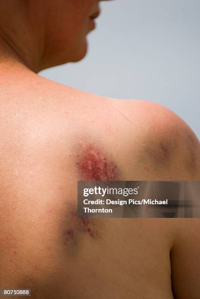 bruising on woman's right shoulder   - bruise fotografías e imágenes de stock