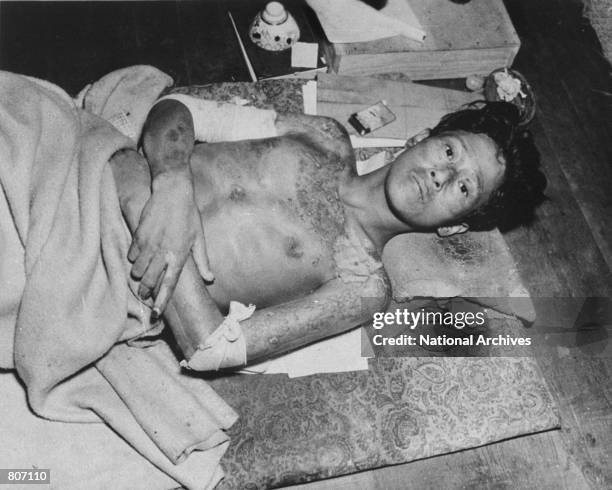 Victim of the atomic bomb explosion in 1945 over Nagasaki, Japan.