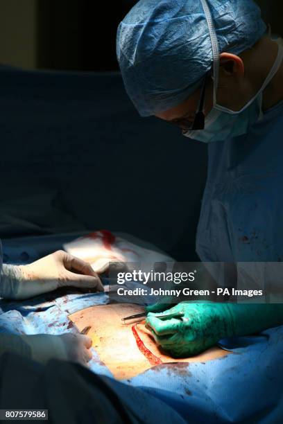 Woman, suffering from cancer of the cervix, undergoes a two hour hysterectomy operation at Barts Hospital in central London.