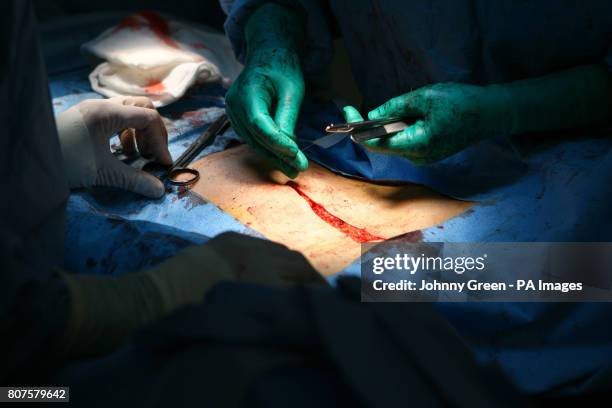 Woman, suffering from cancer of the cervix, undergoes a two hour hysterectomy operation at Barts Hospital in central London.