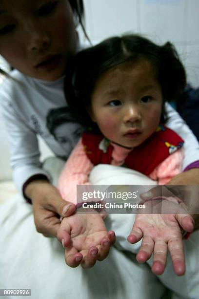 Young girl aged two who suffers from the hand, foot and mouth disease caused by the enterovirus 71, displays her hands in a hospital on April 28,...