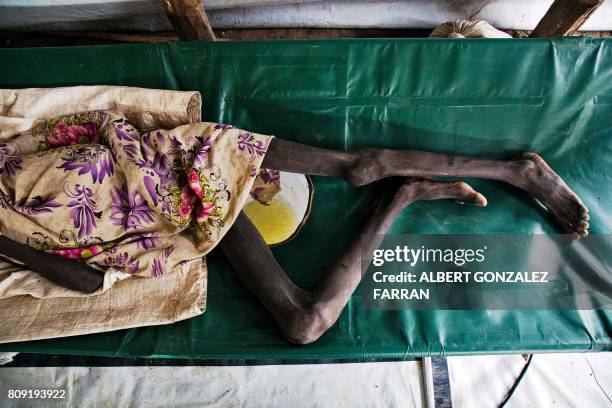 Duor Jany seriously affected with cholera, lays on a bed, at the clinic run by Doctors Withouth Borders in Lankien, Jonglei, South Sudan on July 5,...