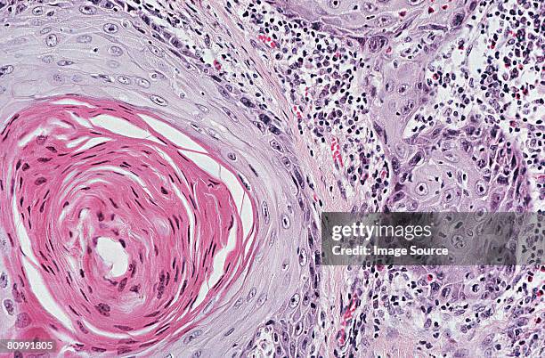 squamous cell carcinoma - carcinoma stock pictures, royalty-free photos & images