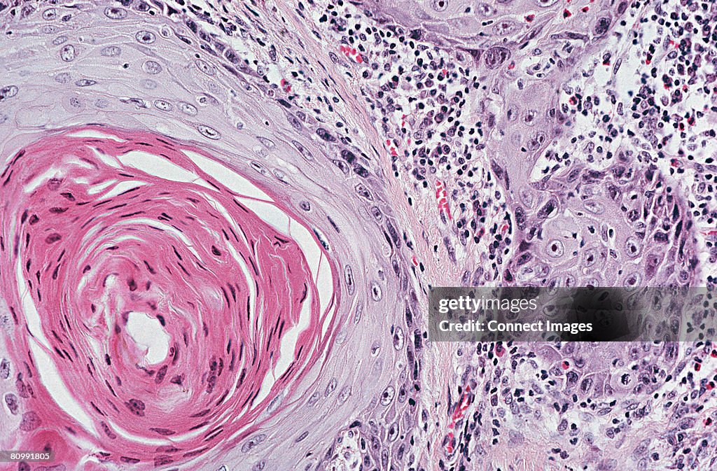 Squamous cell carcinoma