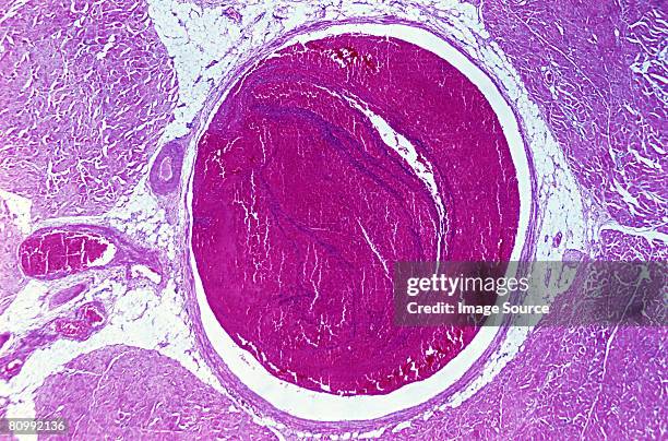 venous thrombosis - micrografía científica fotografías e imágenes de stock