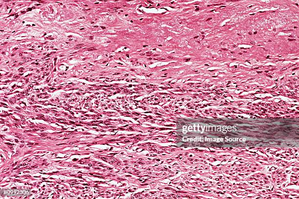 myometrium - uterine wall fotografías e imágenes de stock