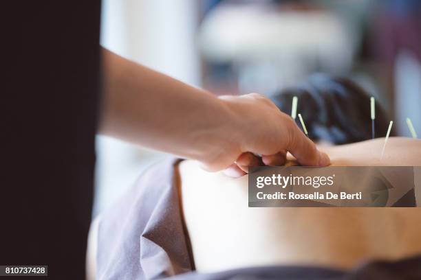 patient receiving acupuncture treatment - agulha de acupuntura imagens e fotografias de stock