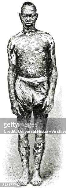 Man with Mottled Skin, Loango Coast, Africa, Illustration, 1885.