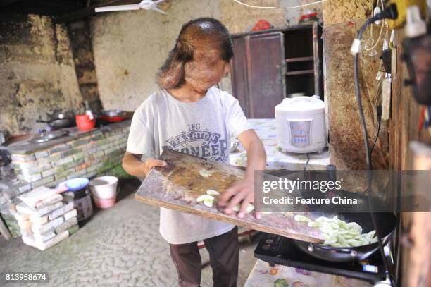 Chi Zhoujing cooks at home in the remote Shangfeng village on June 21, 2017 in Minqing, China. The 24-year-old man developed tumors on his head...