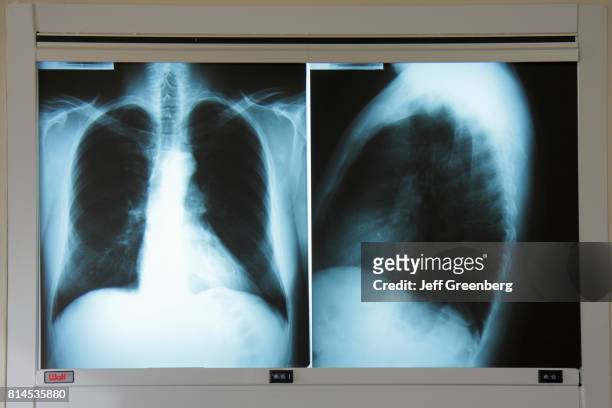 An adult male chest x-ray at Mount Sinai Medical Center.