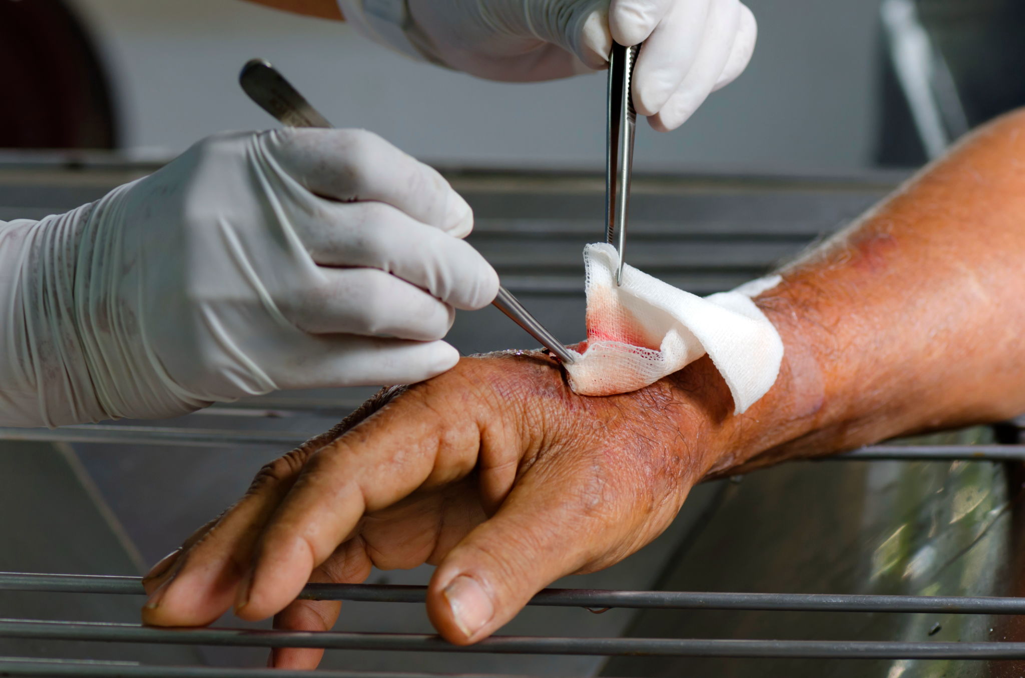 cleaning wound