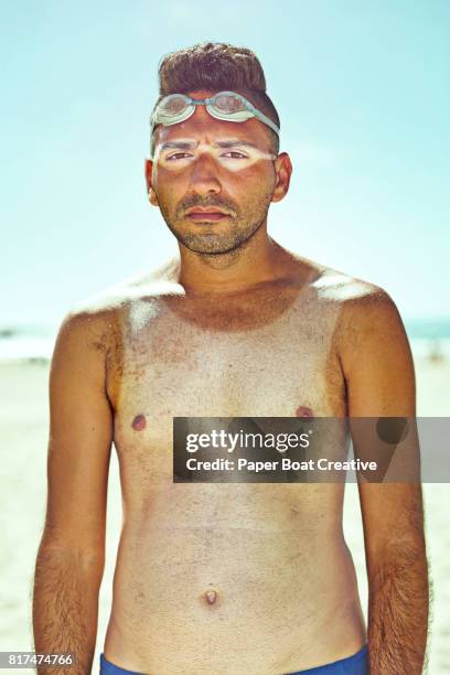 sunburned guy with tan lines sad standing at the beach in the summer sun clear skies - rash ストックフォトと画像